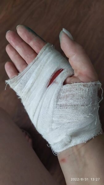    Женщина получила травмы рук и ног Анастасия Красушкина