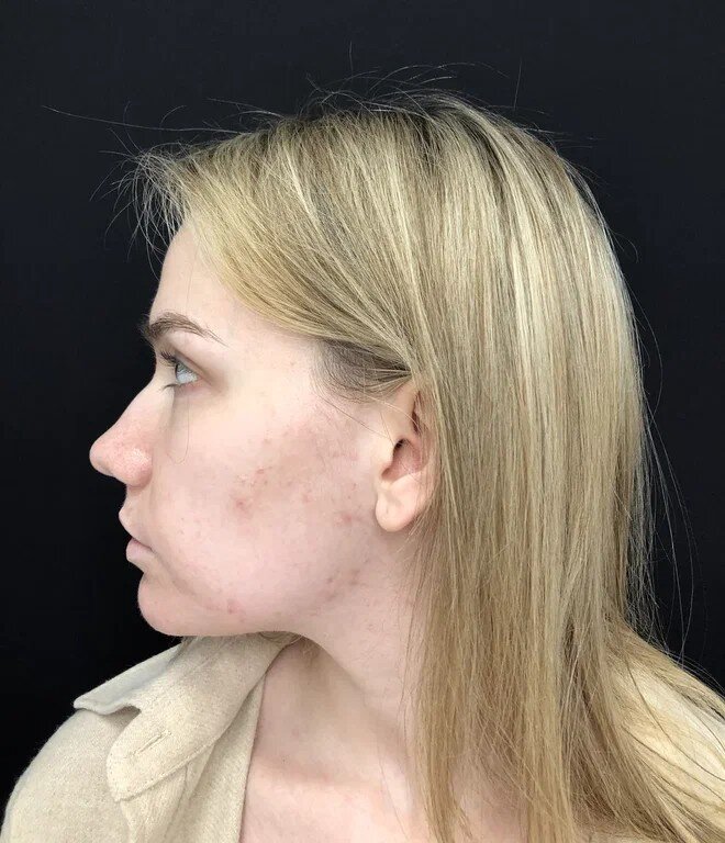 До ринопластики.