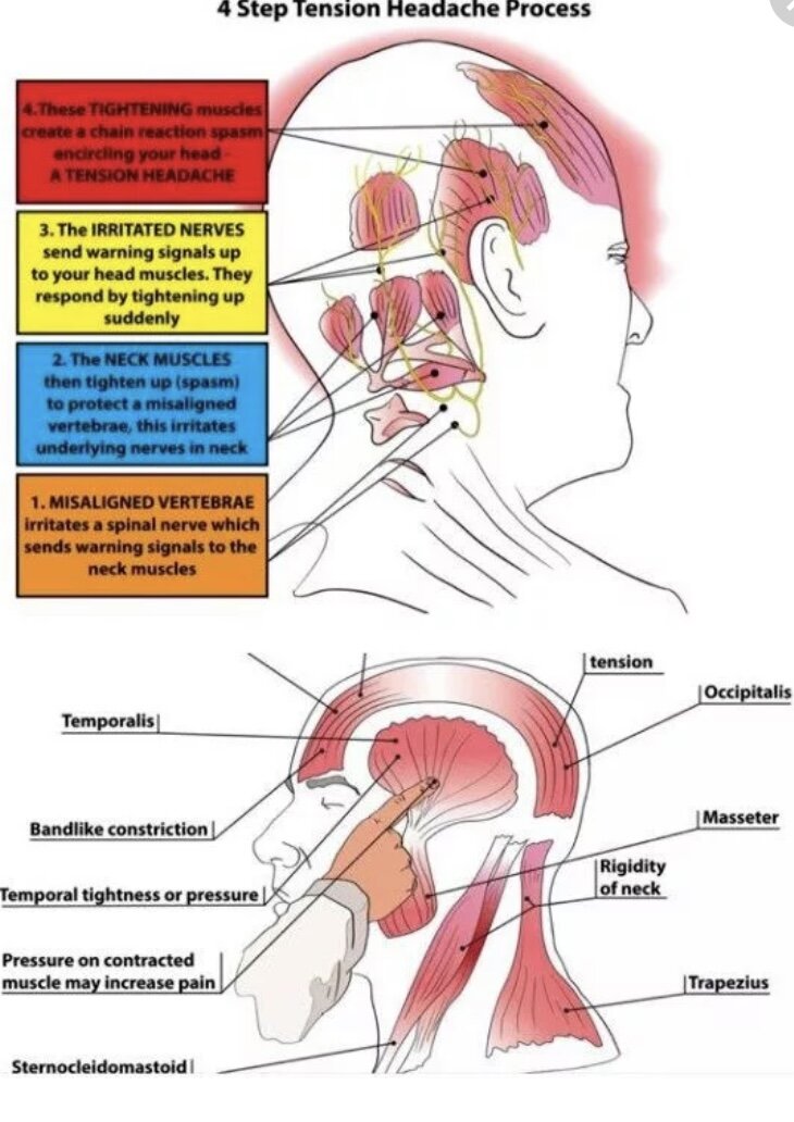 Напряжение в голове. Головная боль мышечного напряжения. Мышечное напряжение в голове. Tension headache.