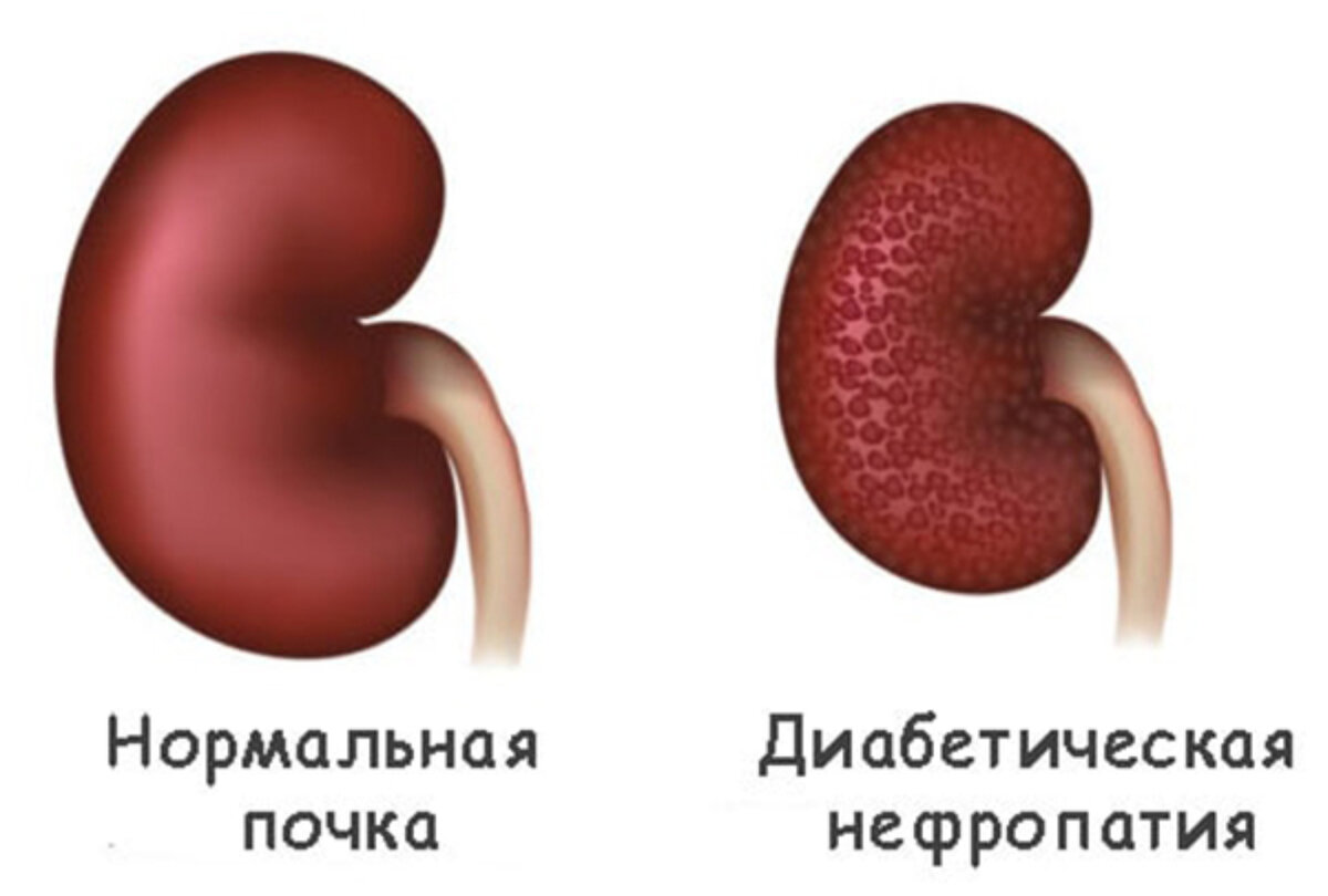 Почки при диабете. Диабетическая нефропатия (патология почек);. Сахарный диабет 2 типа нефропатия. Нефропатия при сахарном диабете. Нефропатия почек при сахарном диабете.