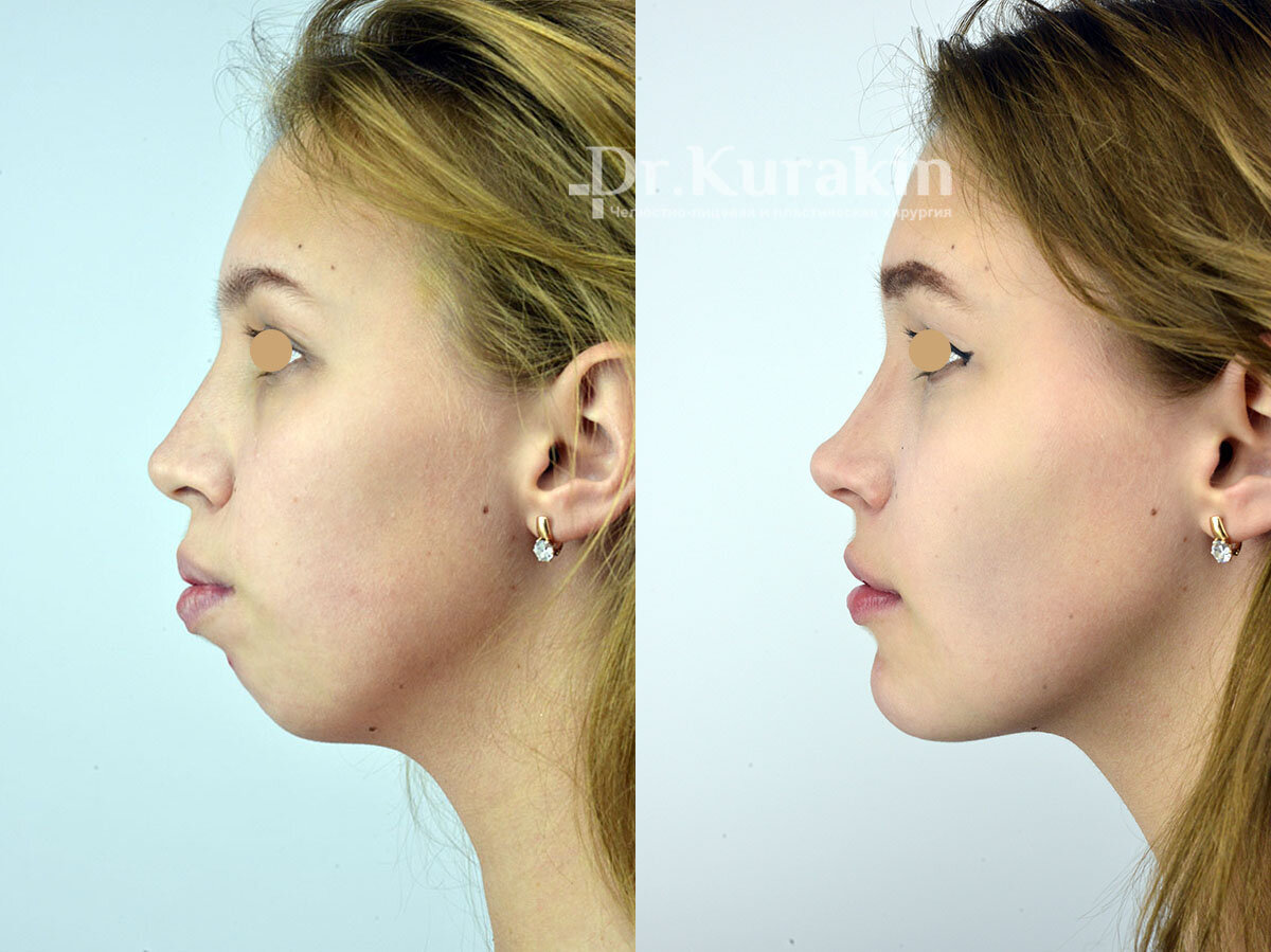 Глубокий прикус лицо в профиль. Брекеты до и после лицо в профиль. Ортогнатическая операция верхней челюсти. Операция остеотомия верхней челюсти. Ортогнатическая операция мезиальный прикус.