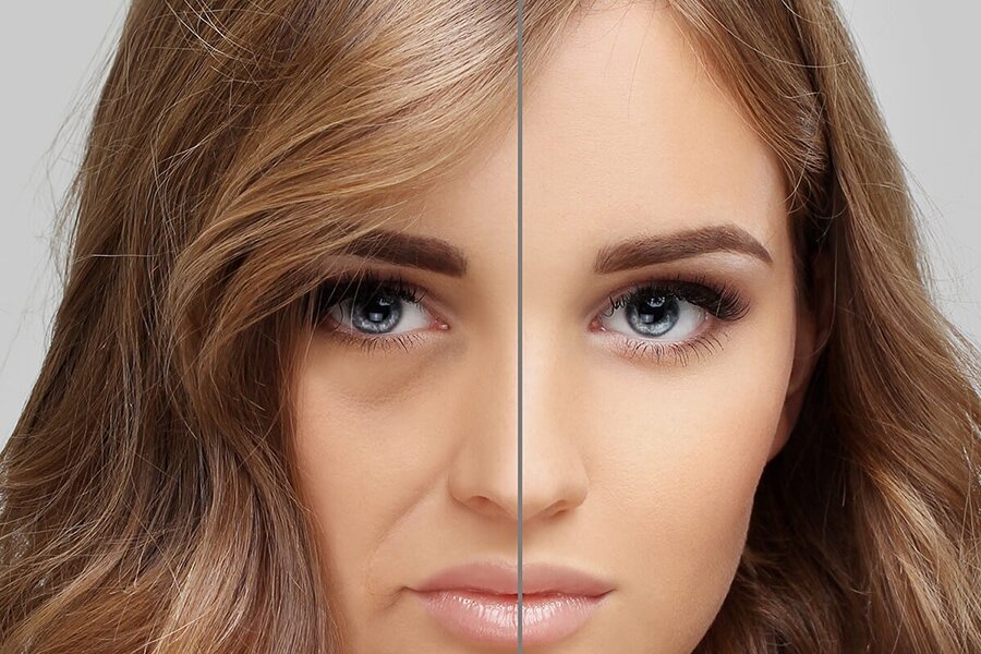 Носогубные морщины