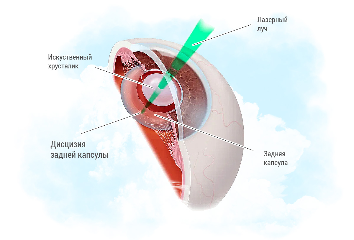 Вторичная катаракта после операции. Вторичная катаракта лазерная дисцизия. Вторичная катаракта фиброз задней капсулы. Лазерная дисцизия задней капсулы хрусталика. Вторичная катаракта фиброз задней капсулы шары Эльшнига.