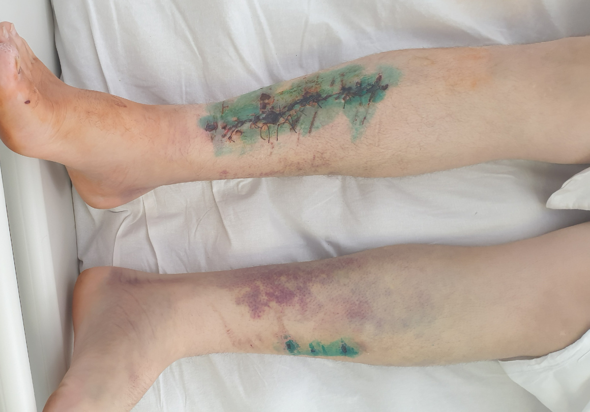 Ссадины и гематомы на голенях 