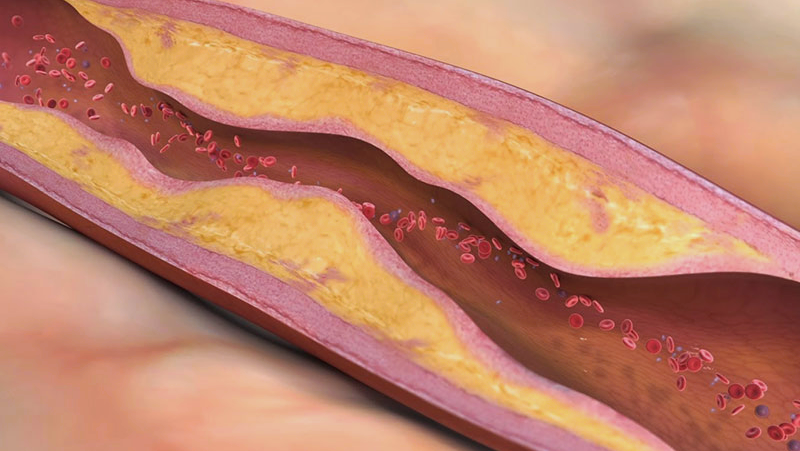 Объёмная модель холестириновых бляшек (жёлтые) и кровотока, представленного линией форменных элементов (эритроцитов, лейкоцитов и тромбоцитов)