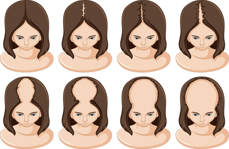    Первые признаки очаговой алопеции у женщин проявляются еще в детстве.