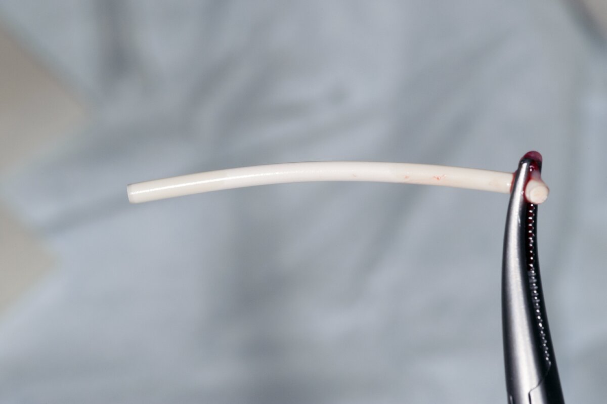    Гормональный имплант перед установкойLegion Media