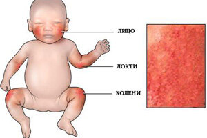 Высыпания на коже. Пищевая аллергия? Реакция на воду?