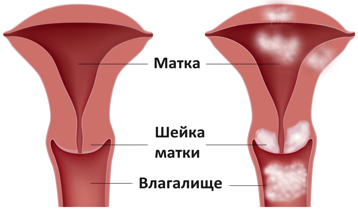 Лейкоплакия вульвы – что это, причины, симптомы заболевания, диагностика и лечение в «Будь Здоров»