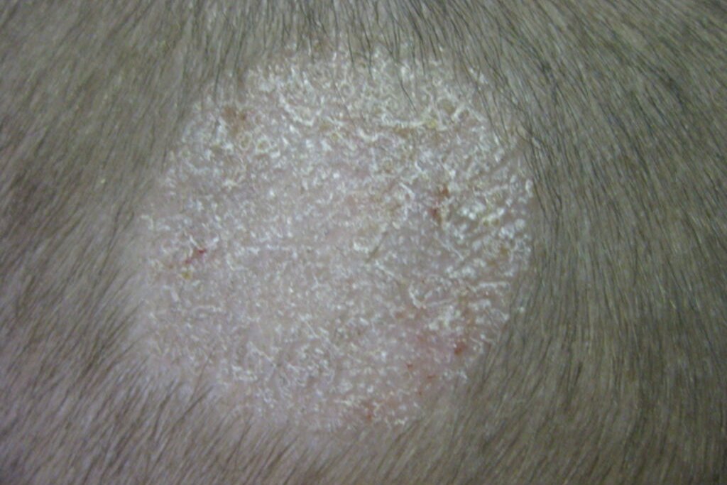 Микроспория при обычном осмотре