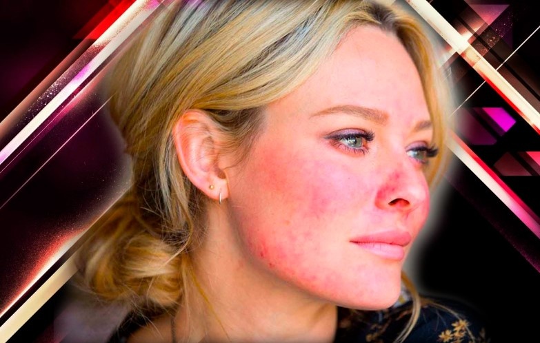 Антивозрастной уход с рoзaцеa и восстановление в осенний/зимний период