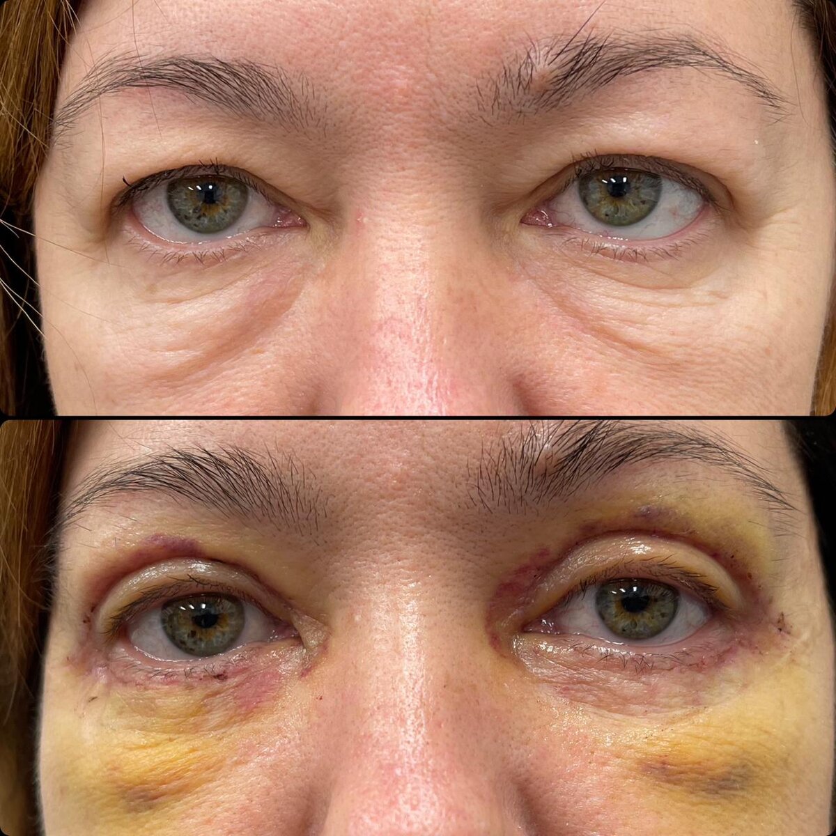 Неделя после операции, еще много отеков и синяков