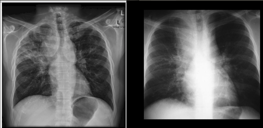 Слева саркаидоз у обычного пациента, справа - туберкулез у ВИЧ+ пациента. Источники [1] и [2].