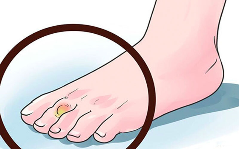 мозоли на ногах