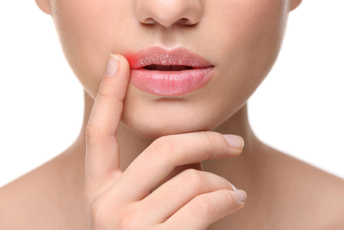 Как лечить простуду на губах: простой герпес