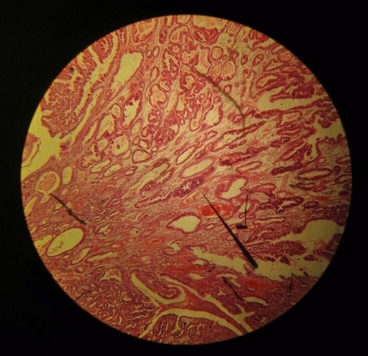 Аденокарцинома желудка. Личный архив.