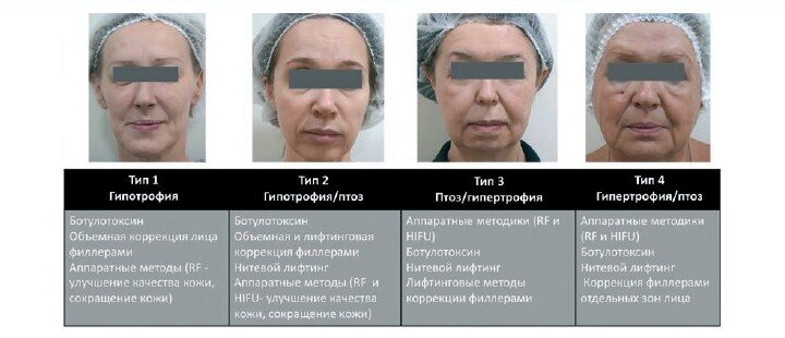 Рисунок 1. Алгоритм выбора метода эстетической коррекции лица для четырех типов старения лица по P. Fundarò.