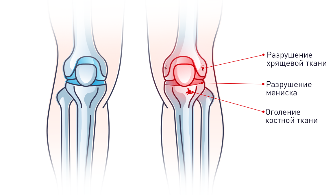 Что такое гонартроз. Гонартроз коленного сустава. Двухсторонний гонартроз коленных суставов. Гонартроз коленного сустава и мениск.