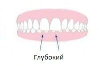 Глубокий – зубы сверху заходят на нижние больше,чем на треть их высоты, за счет чего соединение зубовоказывается нарушено, а вместе с ним меняется и пропорциямежду челюстями (верхняя противоестественно увеличивается);