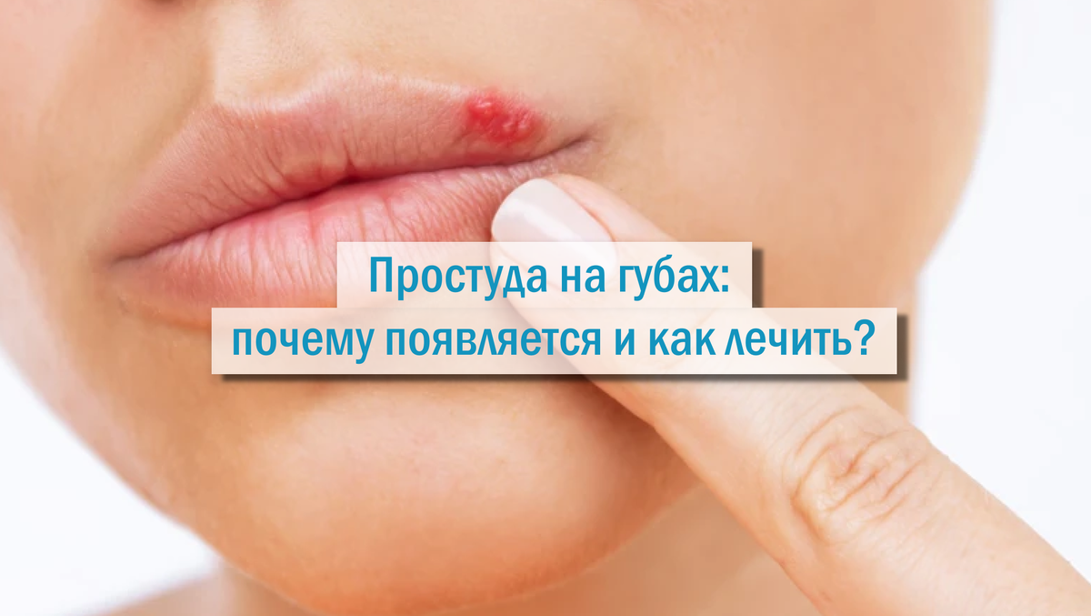 Как выглядит простуда на губах у ребенка Чем лечить герпес во рту и на языке у ребенка, как можно избавиться от белых пуз