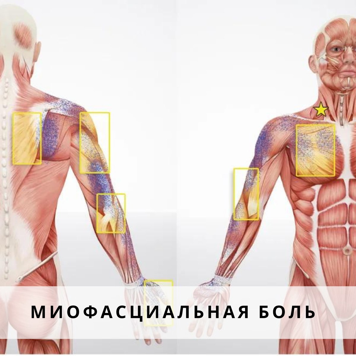 Лечение мышечной. Фасциальные триггерные точки. Миофасциальные триггерные точки. Мышечно-фасциальный болевой синдром. Триггерные мышцы.