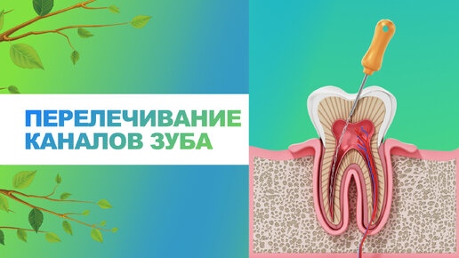 🦷 Перелечивание каналов зуба