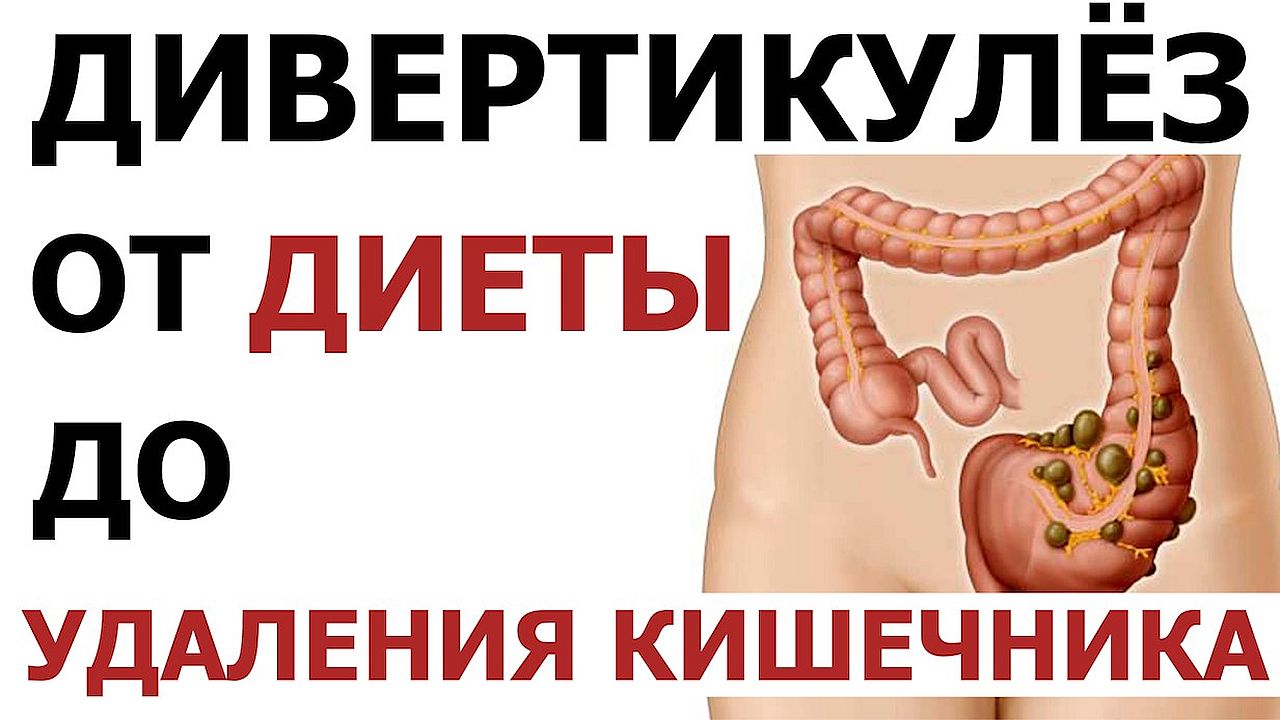 Дивертикулит: симптомы, диагностика и лечение