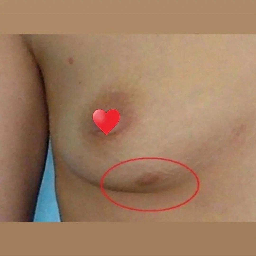 опухоли на груди у женщин фото 42