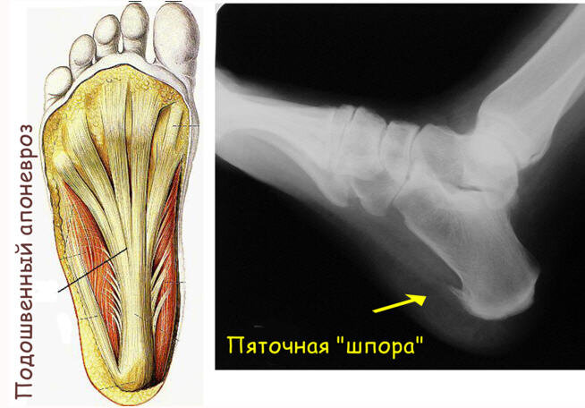 Пяточная шпора: причины, симптомы, лечение