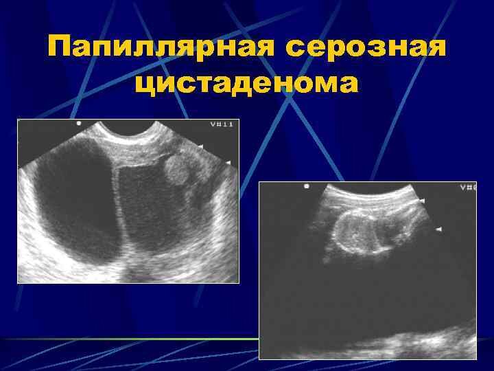 Серозная папиллярная цистаденома