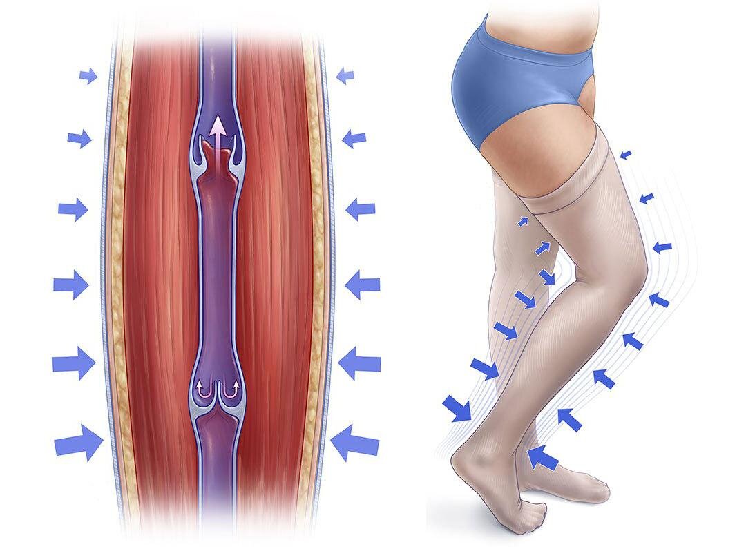 Компрессионная терапия нижних конечностей