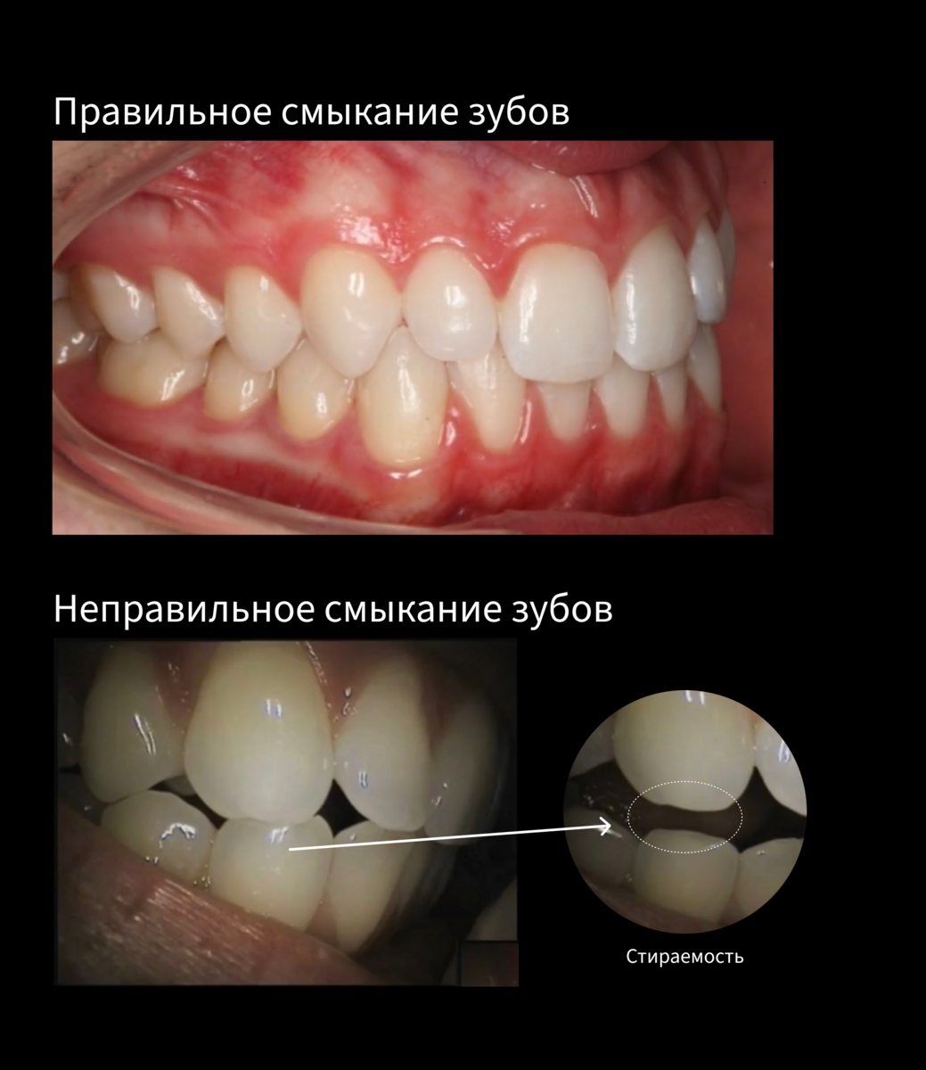 Стертые зубы (истирание зубов)