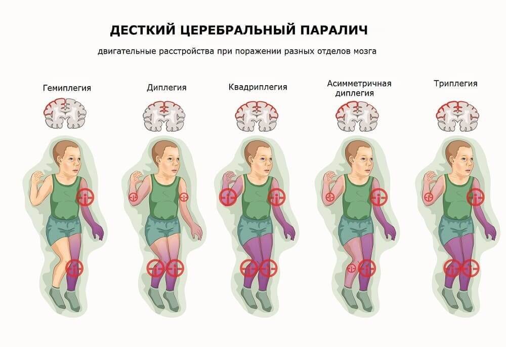 Способности детей с ДЦП напрямую зависят от того, какой именно участок мозга поражен