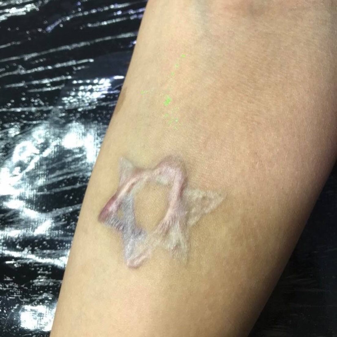 Шрамы от использования непрофессионального оборудования. 