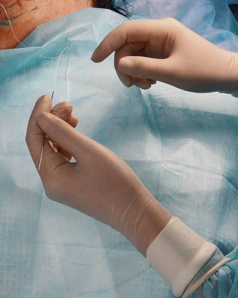 Установка нитей