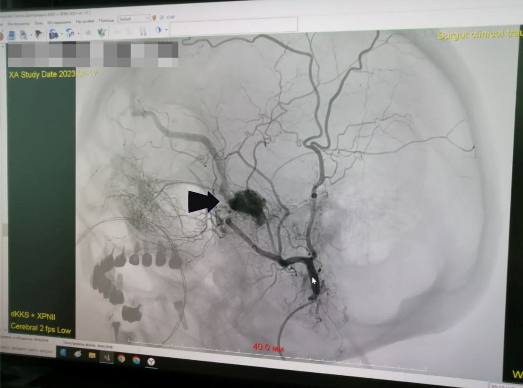    Хирурги Сургута провели 12-часовую операцию на головном мозге, чтобы спасти женщину от слепоты