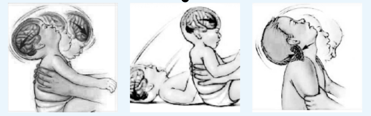 Тряска младенцев. Синдром встряхнутого ребенка. Тремор у ребенка рук и головы. Синдром детского сотрясения. Синдром тряски младенца.