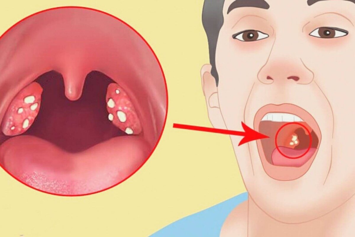 Тонзиллит: признаки, симптомы, лечение - МедКом
