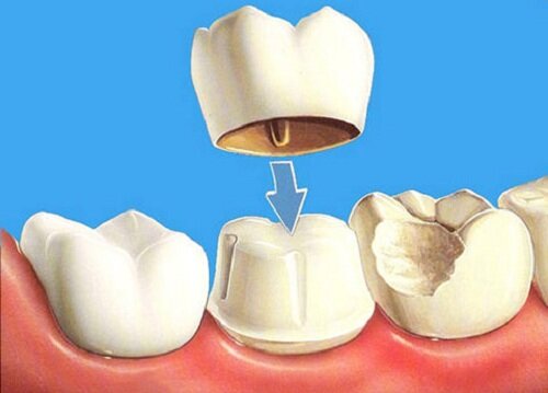 Стоматолог Наталья Кадькалова: как понять, нужно ли удалять зуб