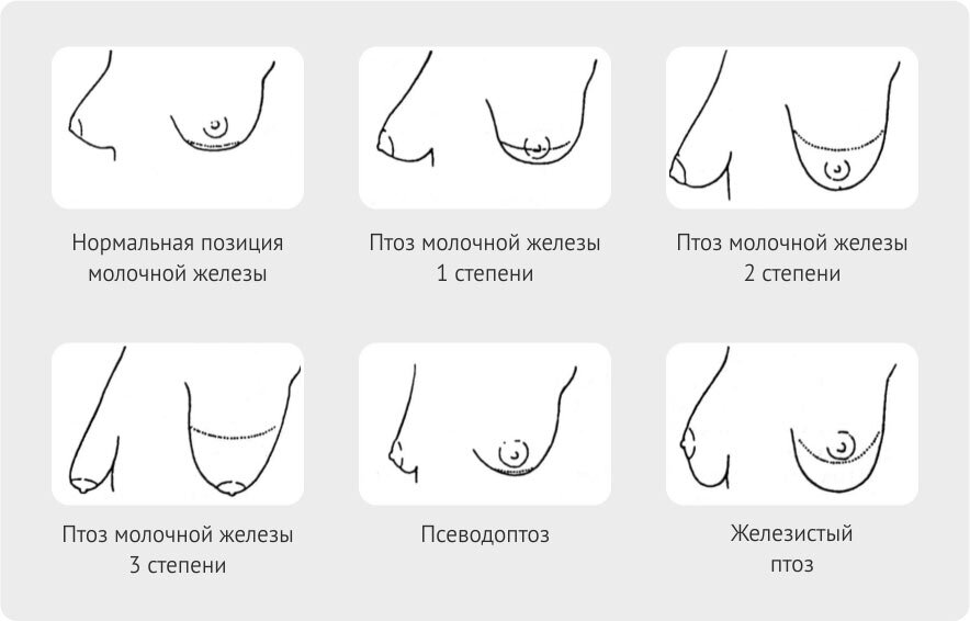 Подтяжка груди: ответы на 10 актуальных вопросов | Наиболее полная информация в 2021 году