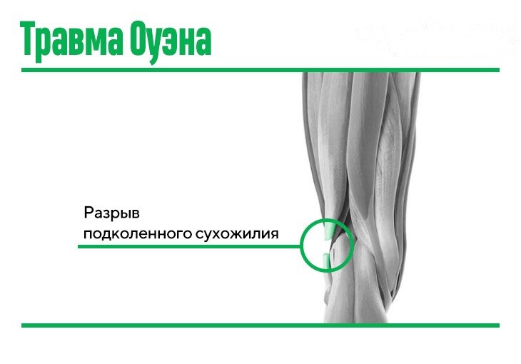 Лечение вывихов, растяжений, разрывов связок