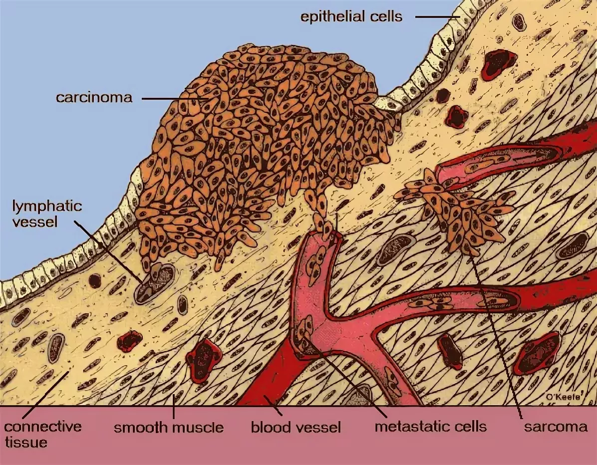 Злокачественная опухоль на примере САРКОМЫ мягких тканей
