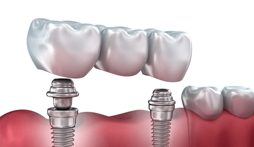 Если не хватает 3-4 зубов, мостовидный протез устанавливается на 2 импланта