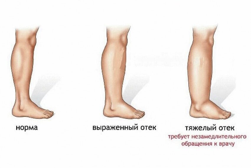 Отёки при беременности