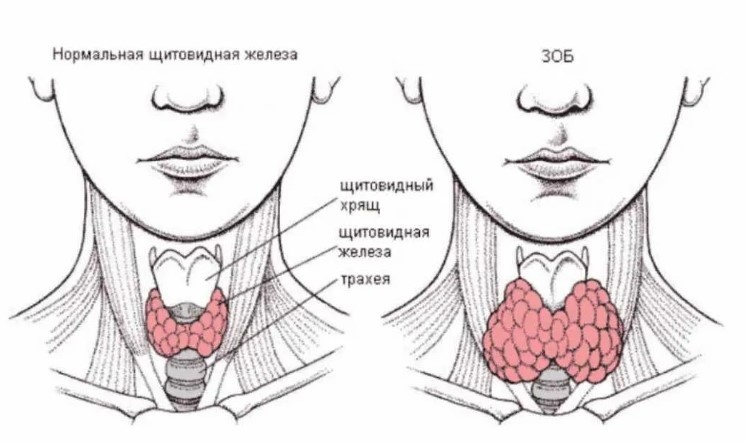Зоб: симптомы, виды и лечение