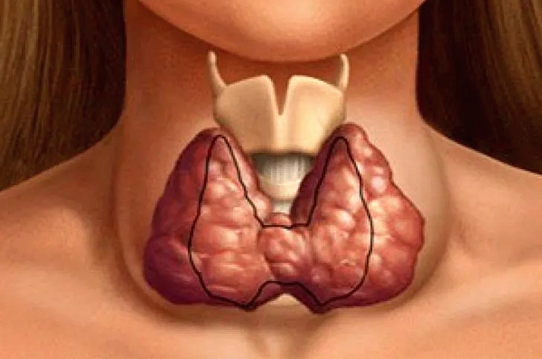 Как живете без щитовидной железы