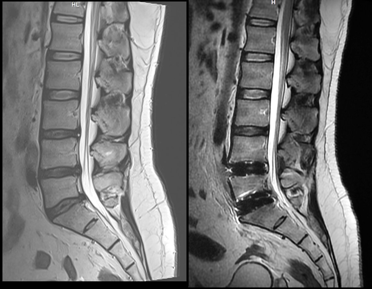 МРТ на 2ой день после операции. 2022г До и после. Более информативно будет через 3 месяца. Сейчас много отёков.
