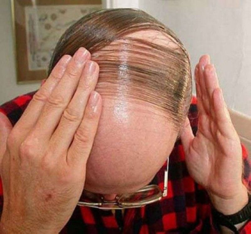 Hair transplants can CURE migraines, a study has revealed The Sun