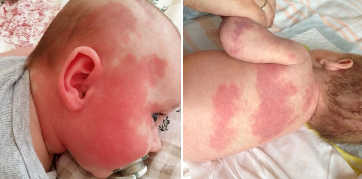 Красное родимое пятно. | Центр сосудистой патологии "ГЕМАНГИОМА" | Дзен