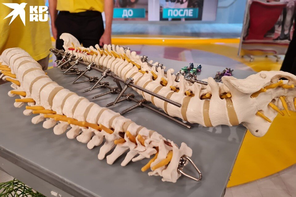     С первого класса девочка страдала сколиозом, ЛФК и массаж не помогали. Фото: Пресс-служба НИИТО имени Цивьяна